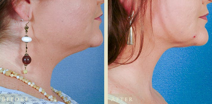 Neck Liposuction Before & After Gallery - Patient 433700 - Image 3