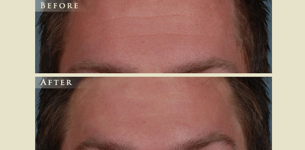 Botox® and Fillers Before & After Gallery - Patient 123264 - Image 1
