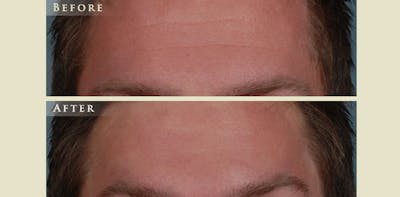 Botox® and Fillers Before & After Gallery - Patient 123264 - Image 1
