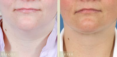 Neck Liposuction Before & After Gallery - Patient 247887 - Image 1