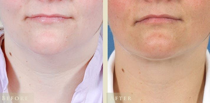 Neck Liposuction Before & After Gallery - Patient 247887 - Image 1