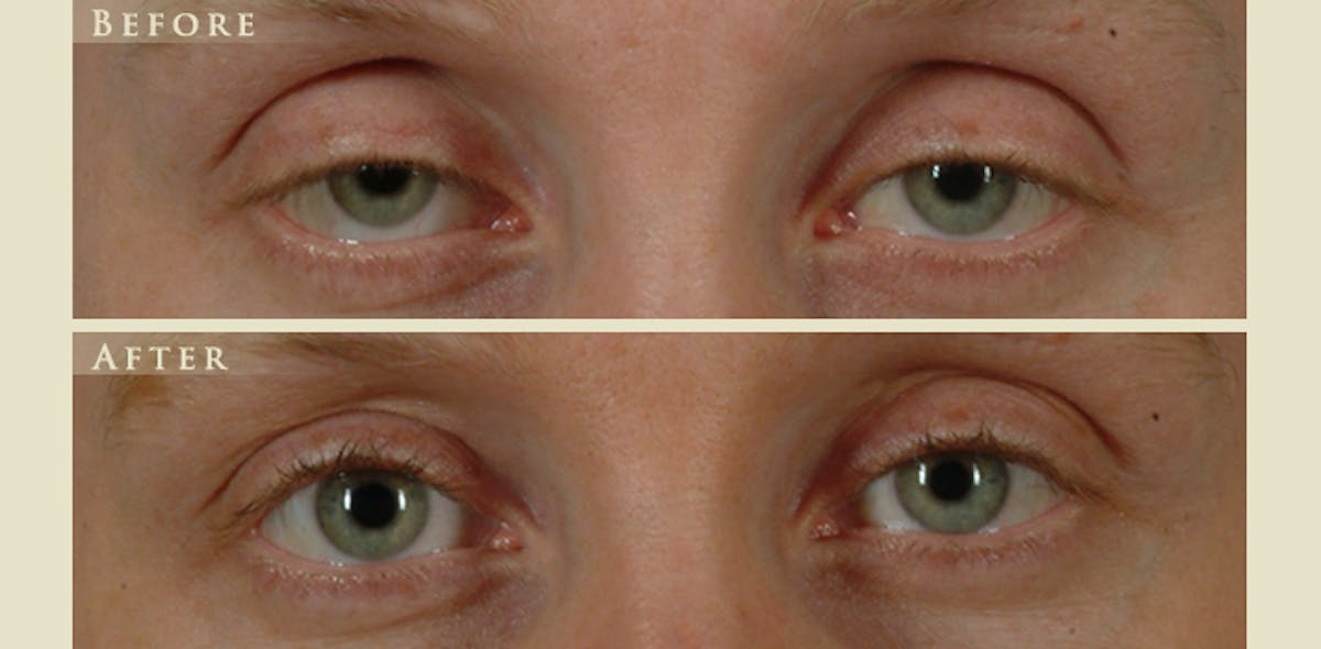Eyelid Lift Before & After Gallery - Patient 111885 - Image 1