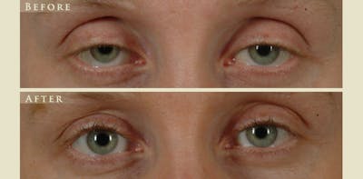 Eyelid Lift Before & After Gallery - Patient 111885 - Image 1