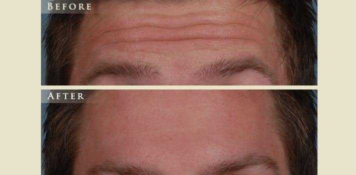 Botox® and Fillers Before & After Gallery - Patient 123264 - Image 2