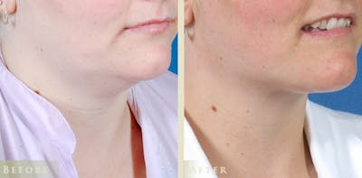 Neck Liposuction Before & After Gallery - Patient 247887 - Image 2