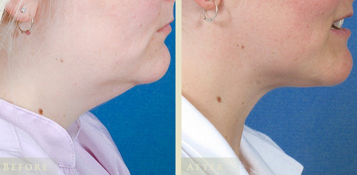 Neck Liposuction Before & After Gallery - Patient 247887 - Image 3