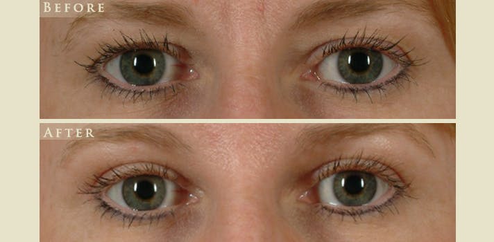 Eyelid Lift Before & After Gallery - Patient 170501 - Image 1