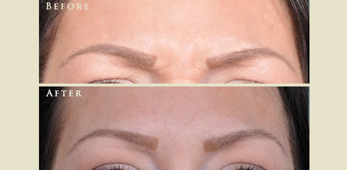 Botox® and Fillers Before & After Gallery - Patient 342795 - Image 1