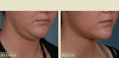 Neck Liposuction Before & After Gallery - Patient 202020 - Image 1