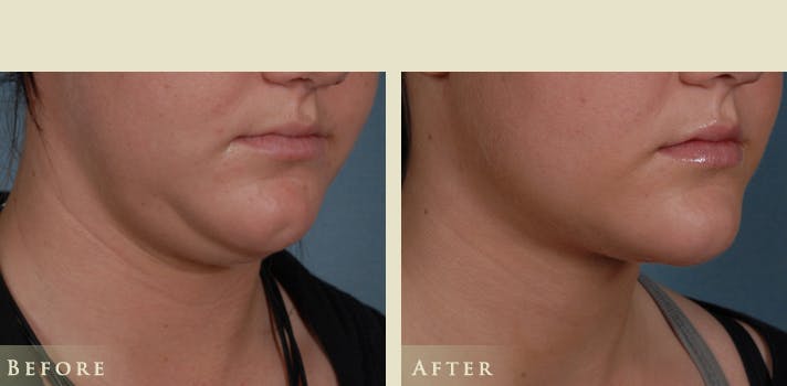 Neck Liposuction Before & After Gallery - Patient 202020 - Image 1