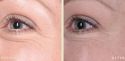 Botox® and Fillers Before & After Gallery - Patient 342795 - Image 2
