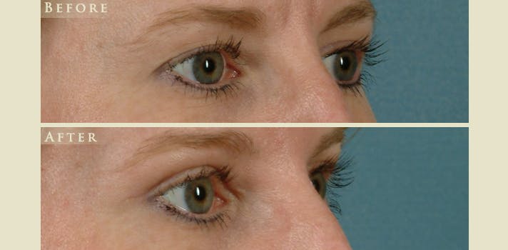 Eyelid Lift Before & After Gallery - Patient 170501 - Image 2