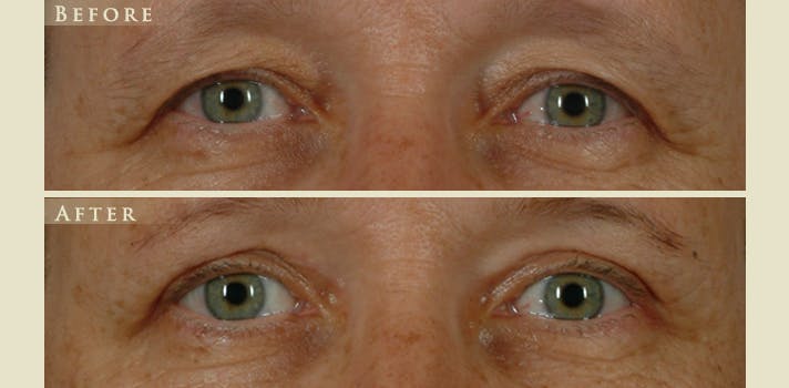 Eyelid Lift Before & After Gallery - Patient 284802 - Image 1