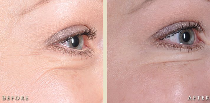 Botox® and Fillers Before & After Gallery - Patient 342795 - Image 3