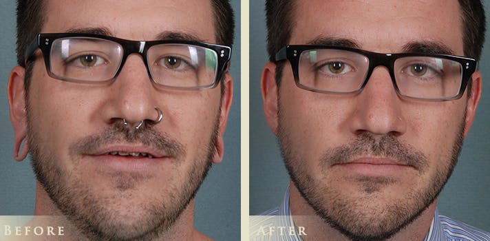 Ear Surgery Before & After Gallery - Patient 132116 - Image 1