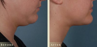 Neck Liposuction Before & After Gallery - Patient 202020 - Image 2