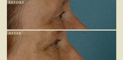Eyelid Lift Before & After Gallery - Patient 284802 - Image 2