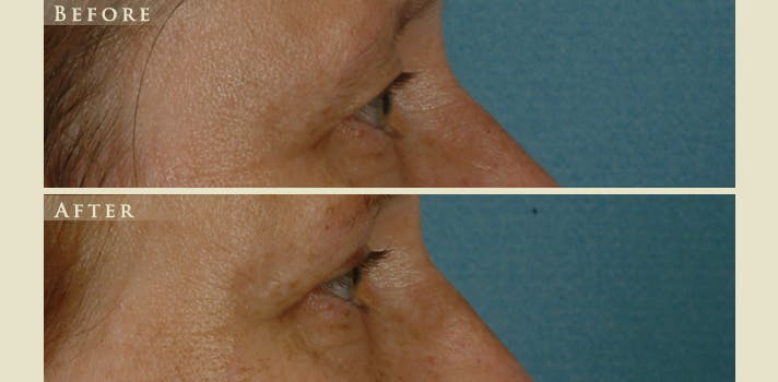 Eyelid Lift Before & After Gallery - Patient 284802 - Image 2