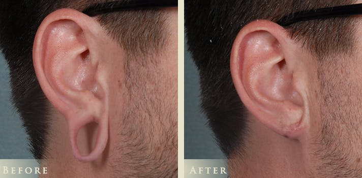 Ear Surgery Before & After Gallery - Patient 132116 - Image 2