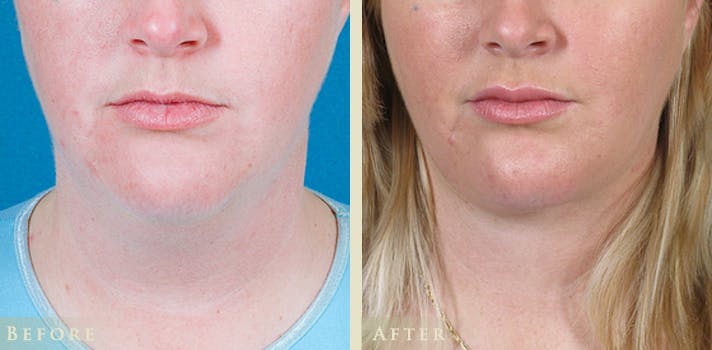 Neck Liposuction Before & After Gallery - Patient 146175 - Image 1