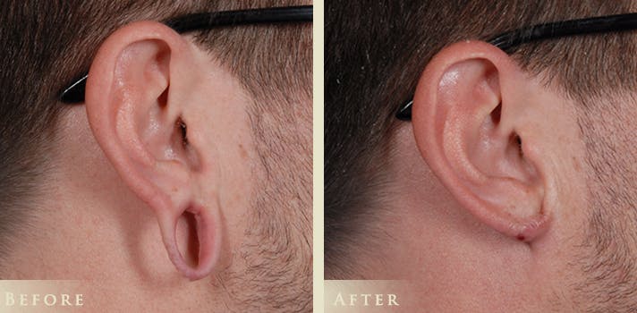 Ear Surgery Before & After Gallery - Patient 132116 - Image 3