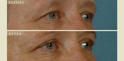 Eyelid Lift Before & After Gallery - Patient 284802 - Image 3