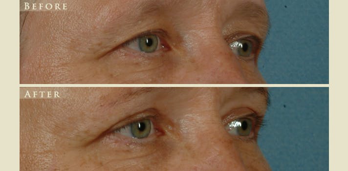 Eyelid Lift Before & After Gallery - Patient 284802 - Image 3