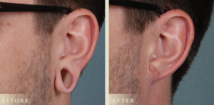 Ear Surgery Before & After Gallery - Patient 132116 - Image 4