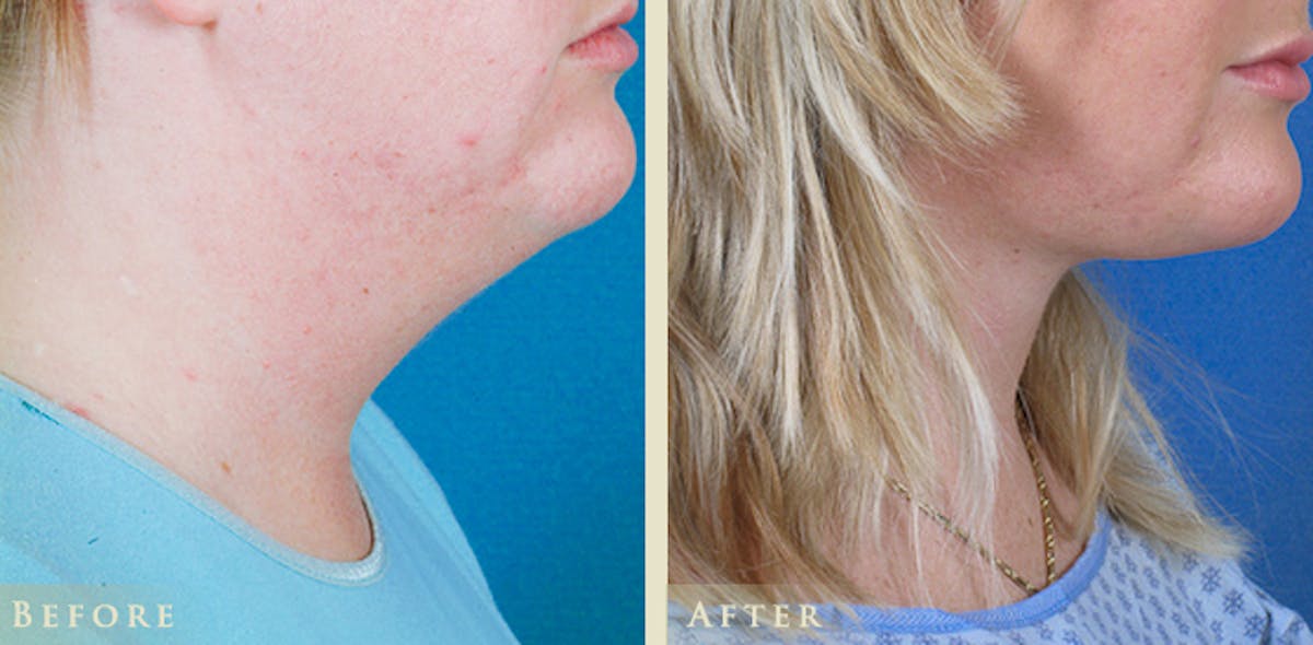 Neck Liposuction Before & After Gallery - Patient 146175 - Image 3