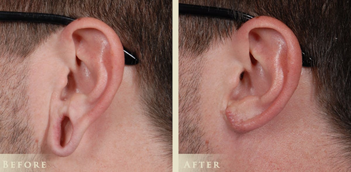 Ear Surgery Before & After Gallery - Patient 132116 - Image 5
