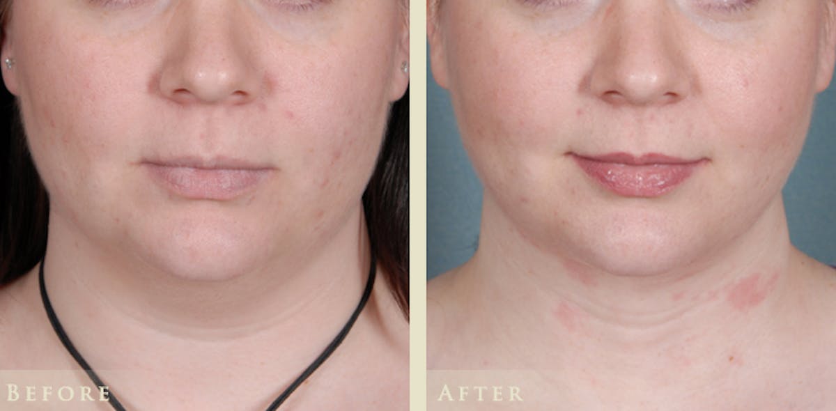 Neck Liposuction Before & After Gallery - Patient 962645 - Image 1