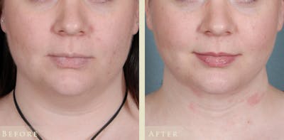 Neck Liposuction Before & After Gallery - Patient 962645 - Image 1