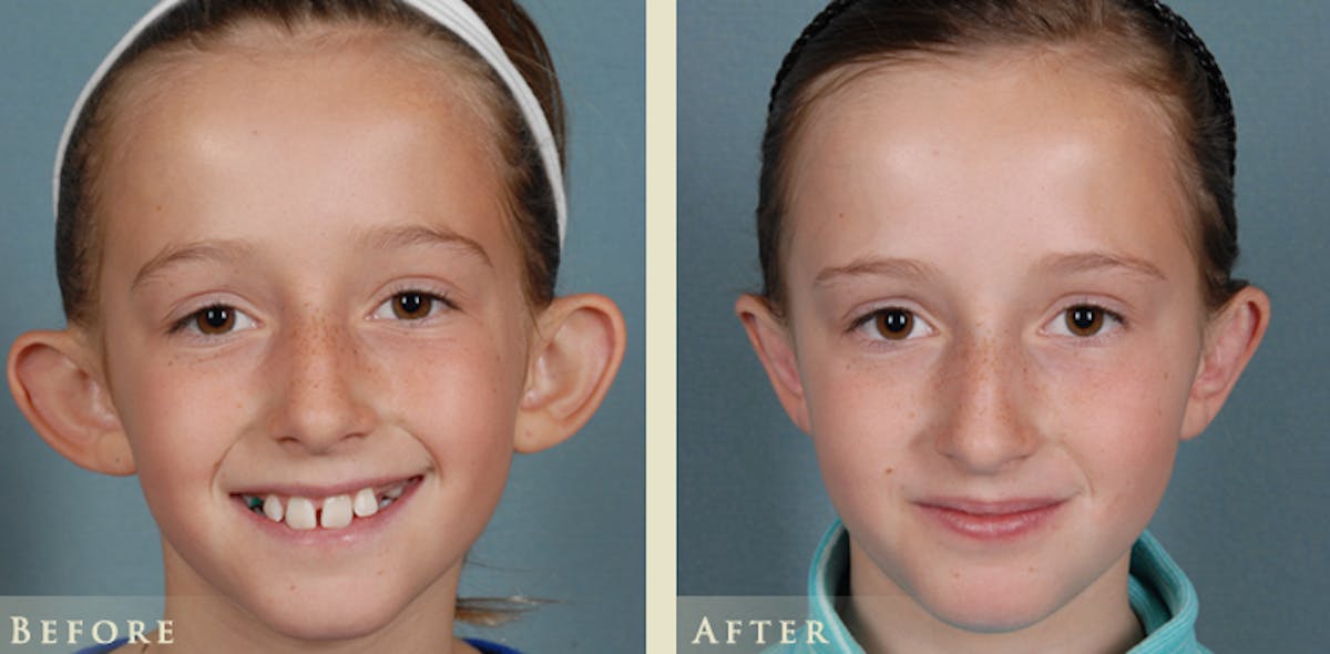 Ear Surgery Before & After Gallery - Patient 136685 - Image 1
