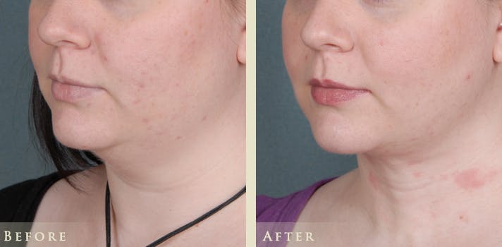 Neck Liposuction Before & After Gallery - Patient 962645 - Image 2
