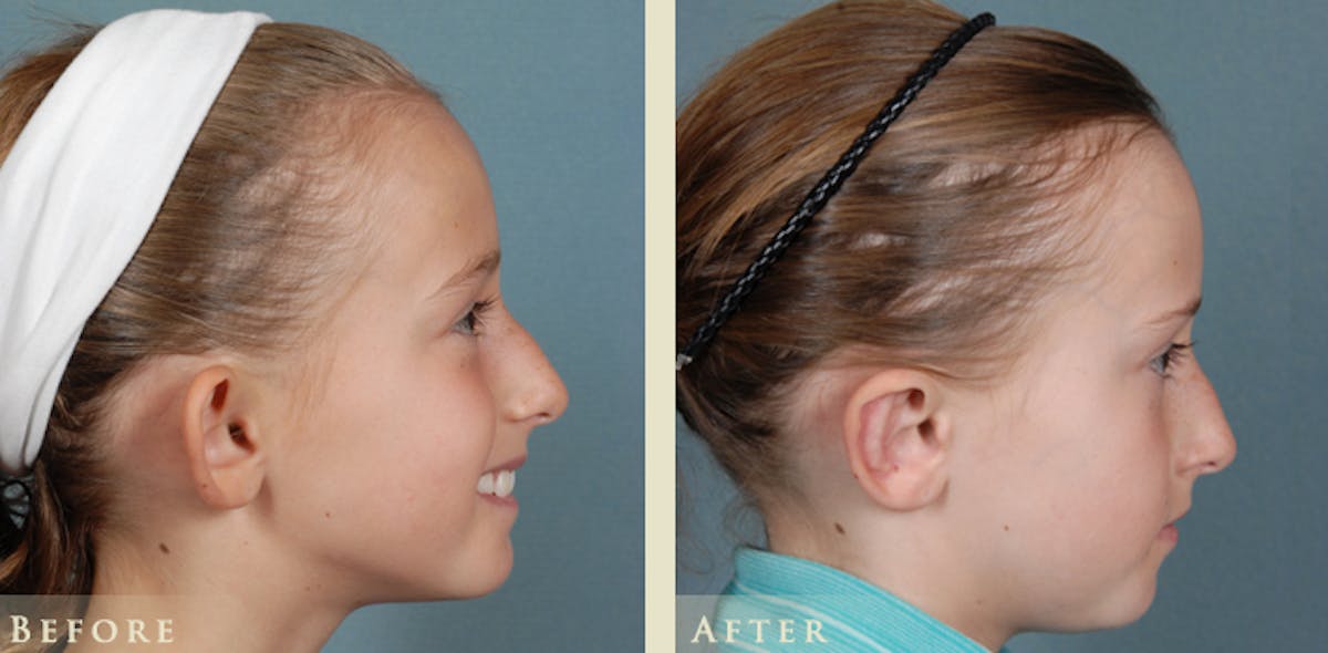 Ear Surgery Before & After Gallery - Patient 136685 - Image 2
