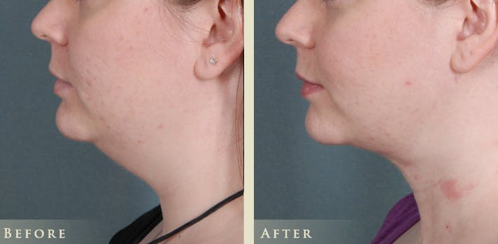 Neck Liposuction Before & After Gallery - Patient 962645 - Image 3
