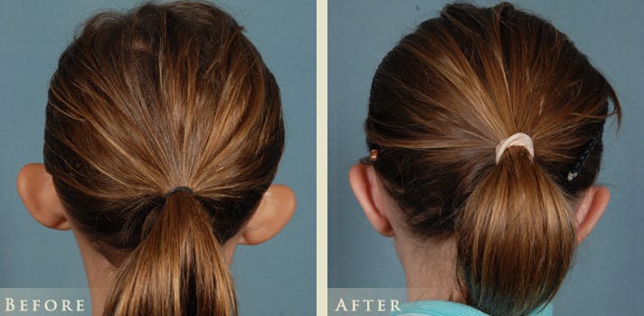 Ear Surgery Before & After Gallery - Patient 136685 - Image 3