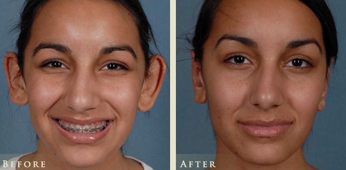 Ear Surgery Before & After Gallery - Patient 303035 - Image 1