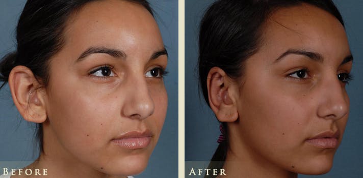 Ear Surgery Before & After Gallery - Patient 398788 - Image 2