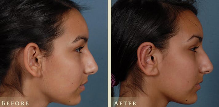Ear Surgery Before & After Gallery - Patient 398788 - Image 3