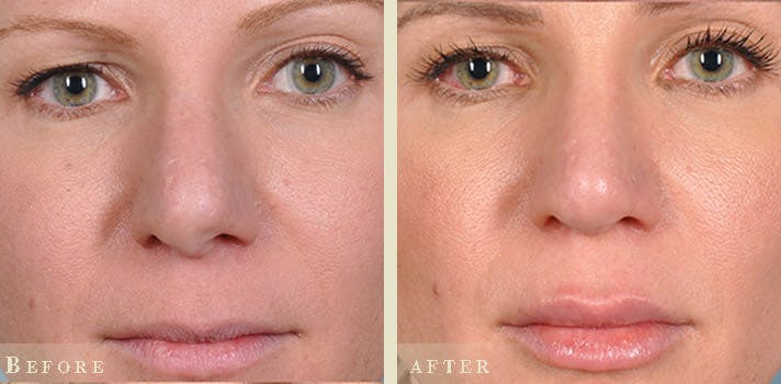 Aesthetic Rhinoplasty Before & After Gallery - Patient 232671 - Image 1