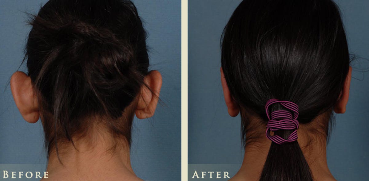 Ear Surgery Before & After Gallery - Patient 303035 - Image 4