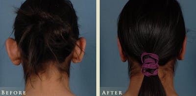 Ear Surgery Before & After Gallery - Patient 398788 - Image 4