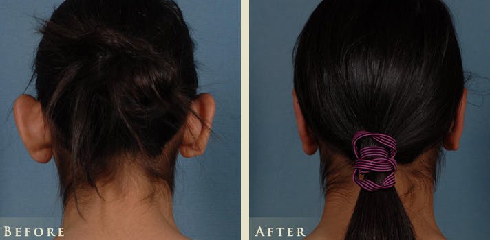Ear Surgery Before & After Gallery - Patient 398788 - Image 4