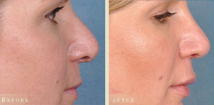 Aesthetic Rhinoplasty Before & After Gallery - Patient 232671 - Image 2