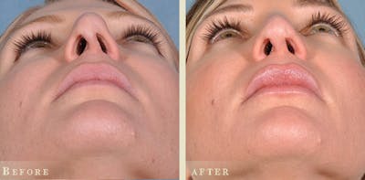 Aesthetic Rhinoplasty Before & After Gallery - Patient 232671 - Image 3