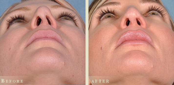 Aesthetic Rhinoplasty Before & After Gallery - Patient 232671 - Image 3