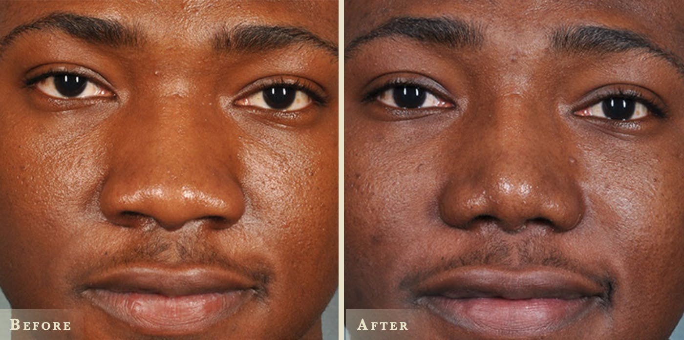 Aesthetic Rhinoplasty Before & After Gallery - Patient 116403 - Image 1