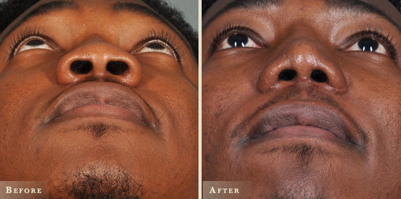 Aesthetic Rhinoplasty Before & After Gallery - Patient 116403 - Image 2