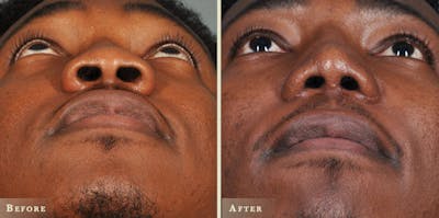 Aesthetic Rhinoplasty Before & After Gallery - Patient 116403 - Image 2